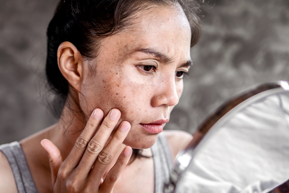 Woman with protruding cheekbones and thin face touches cheek and looks in handheld mirror.