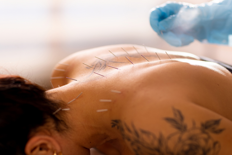 Acupuncturist inserts an acupuncture needle into a woman's back