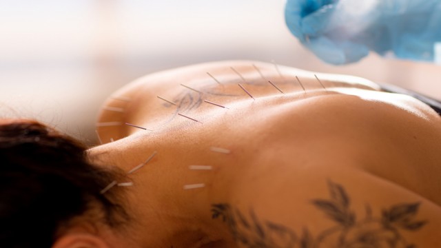 Acupuncturist doctor inserts an acupuncture needle into a woman's back.