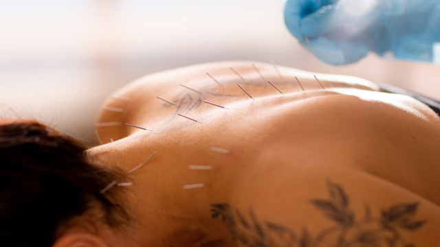 Acupuncturist inserts an acupuncture needle into a woman's back.